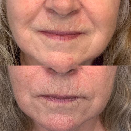 IMG_1219 2 Procell before and after at studio Ki