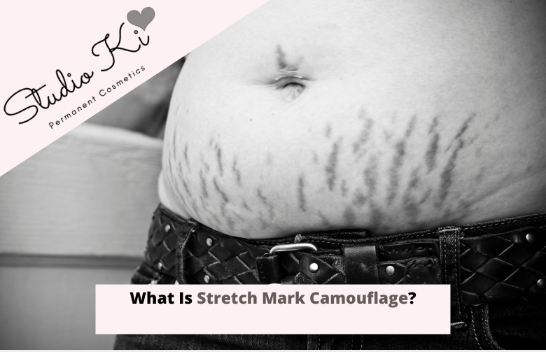 What Is Stretch Mark Camouflage?